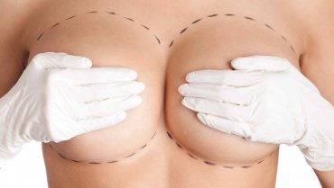 Marire sani cu implanturi mamare (silicoane)  