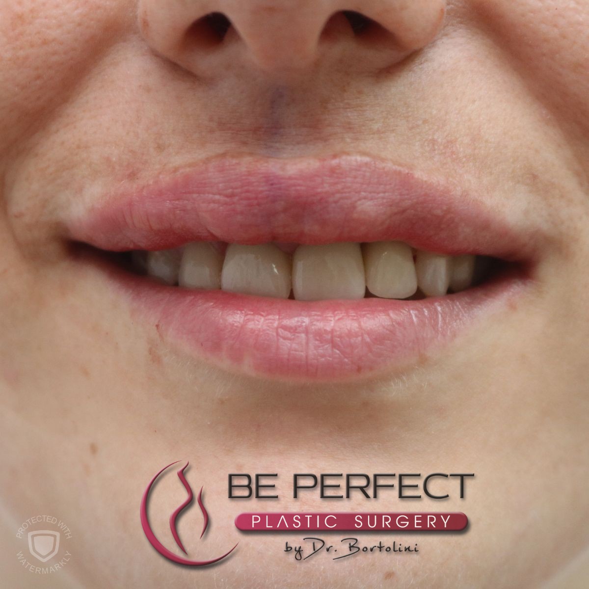 Rezultate reale corectare gummy smile cu toxină botulinică realizată de Dr. Bortolini Alin în București