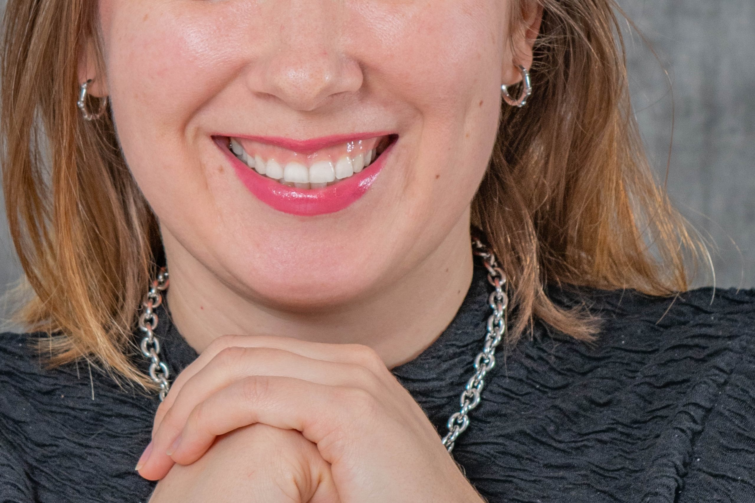 Cum arată un zâmbet gingival – exemplu vizibil înainte de corectare cu toxină botulinică