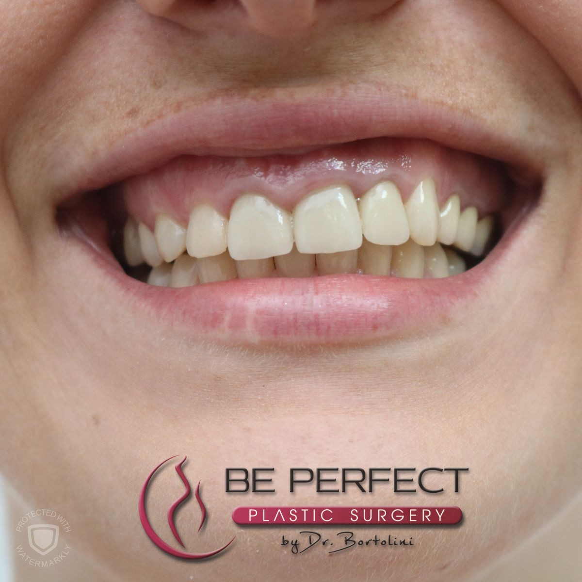 Corectarea zâmbetului gingival – poze înainte și după tratament cu toxină botulinică la Clinica Be Perfect București