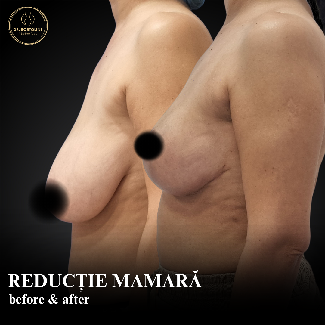 Rezultate reale: poze înainte și după reducția mamară